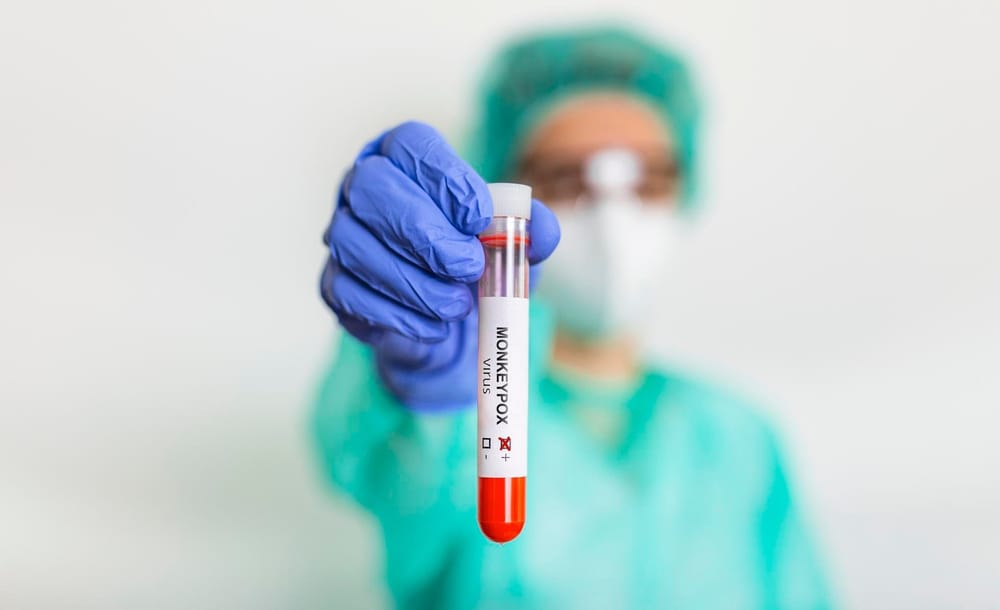 Second case of monkeypox confirmed in Wellington County post image