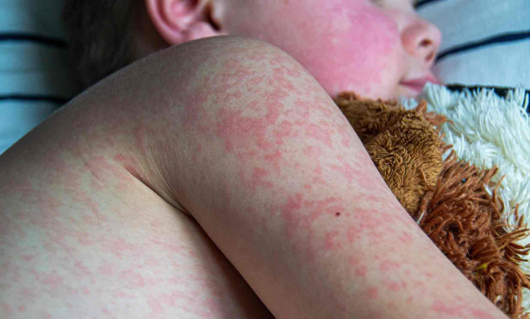 Measles cases climb to 30 in region